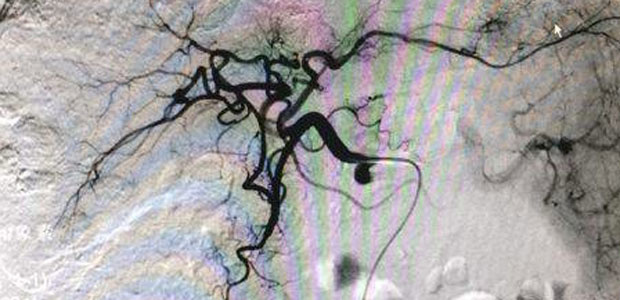 Advanced version of interventional therapy: Microcatheter superselection precisely kills cancer cells
