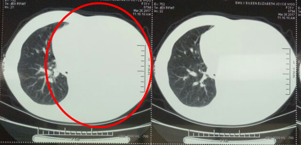  cancer treatment, cervical cancer, cervical adenocarcinoma, minimally invasive therapy, interventional therapy, cryotherapy, St. Stamford Modern Cancer Hospital Guangzhou.