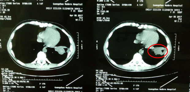  cancer treatment, cervical cancer, cervical adenocarcinoma, minimally invasive therapy, interventional therapy, cryotherapy, St. Stamford Modern Cancer Hospital Guangzhou.