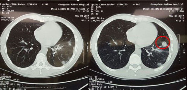  cancer treatment, cervical cancer, cervical adenocarcinoma, minimally invasive therapy, interventional therapy, cryotherapy, St. Stamford Modern Cancer Hospital Guangzhou.
