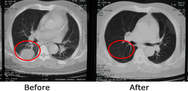 lung cancer, lung cancer treatment, minimally invasive therapy, St. Stamford Modern Cancer Hospital Guangzhou, interventional therapy, cryotherapy, natural therapy, particle implantation, minimally invasive targeted therapy and combination of traditi
